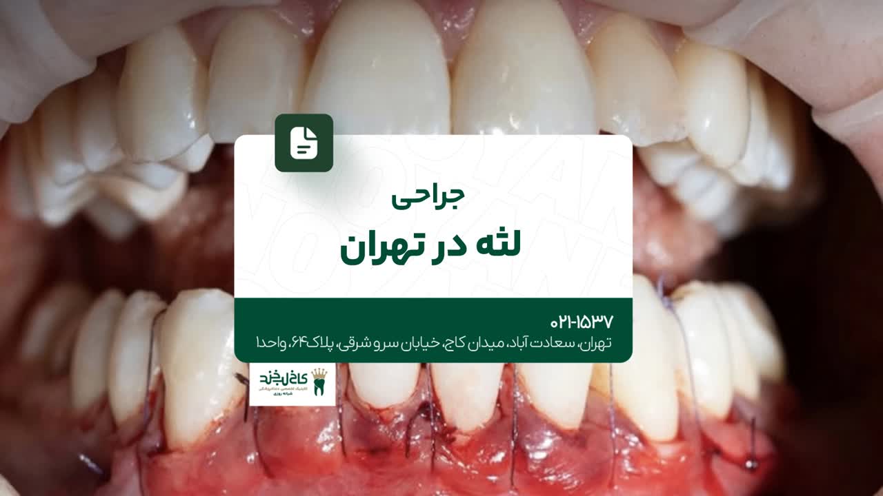 جراحی لثه در تهران جراحی لثه در تهران