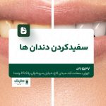 سفید کردن دندان ها