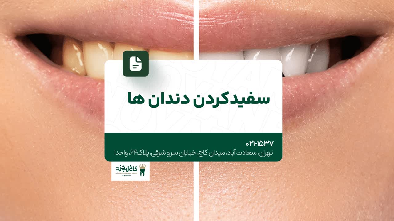 سفید کردن دندان ها سفید کردن دندان ها