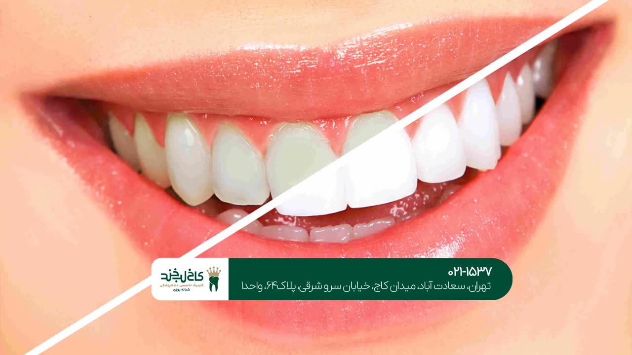 سفید کردن دندان ها با ژل بلیچینگ سفید کردن دندان ها با ژل بلیچینگ