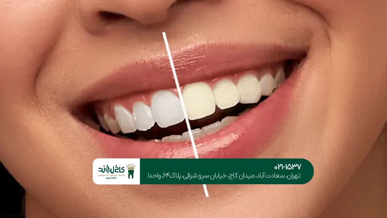 کلینیک دندانپزشکی برای سفید کردن دندان کلینیک دندانپزشکی برای سفید کردن دندان