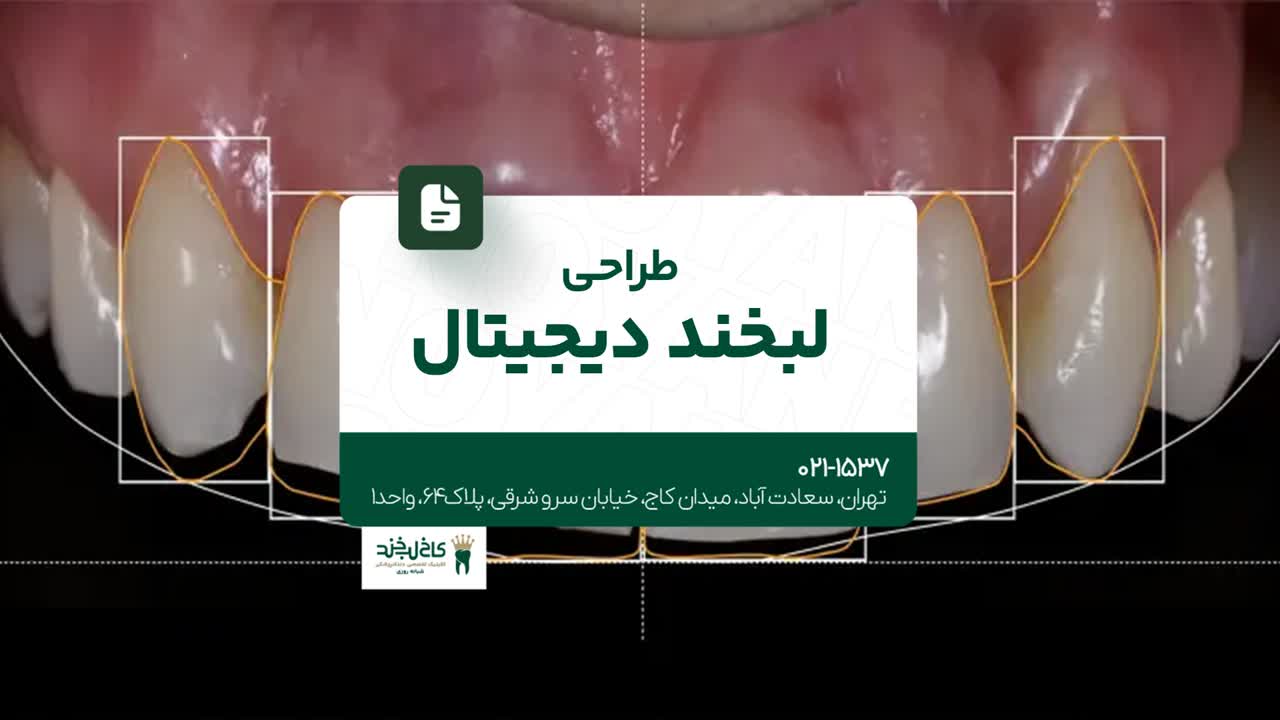 طراحی دیجیتال لبخند طراحی دیجیتال لبخند