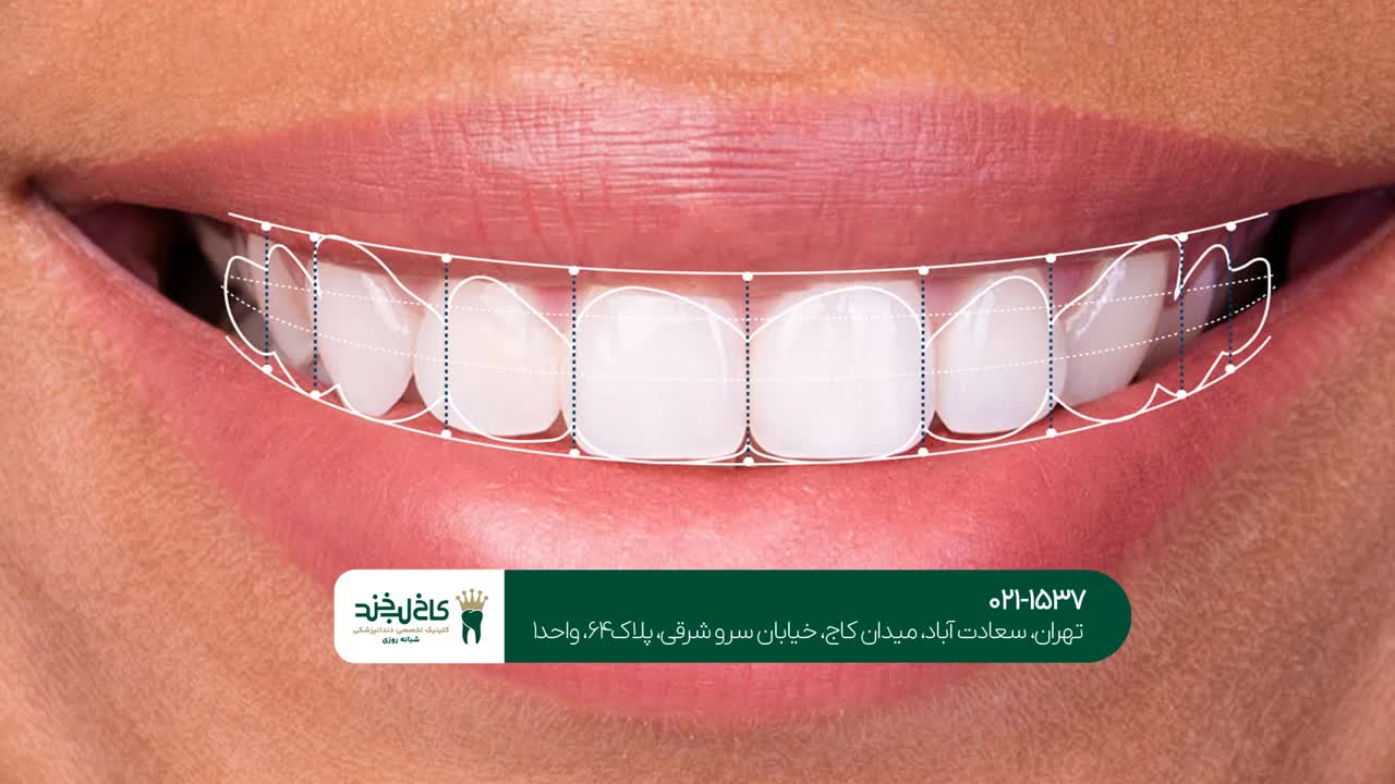 مراحل طراحی دیجیتال لبخند مراحل طراحی دیجیتال لبخند