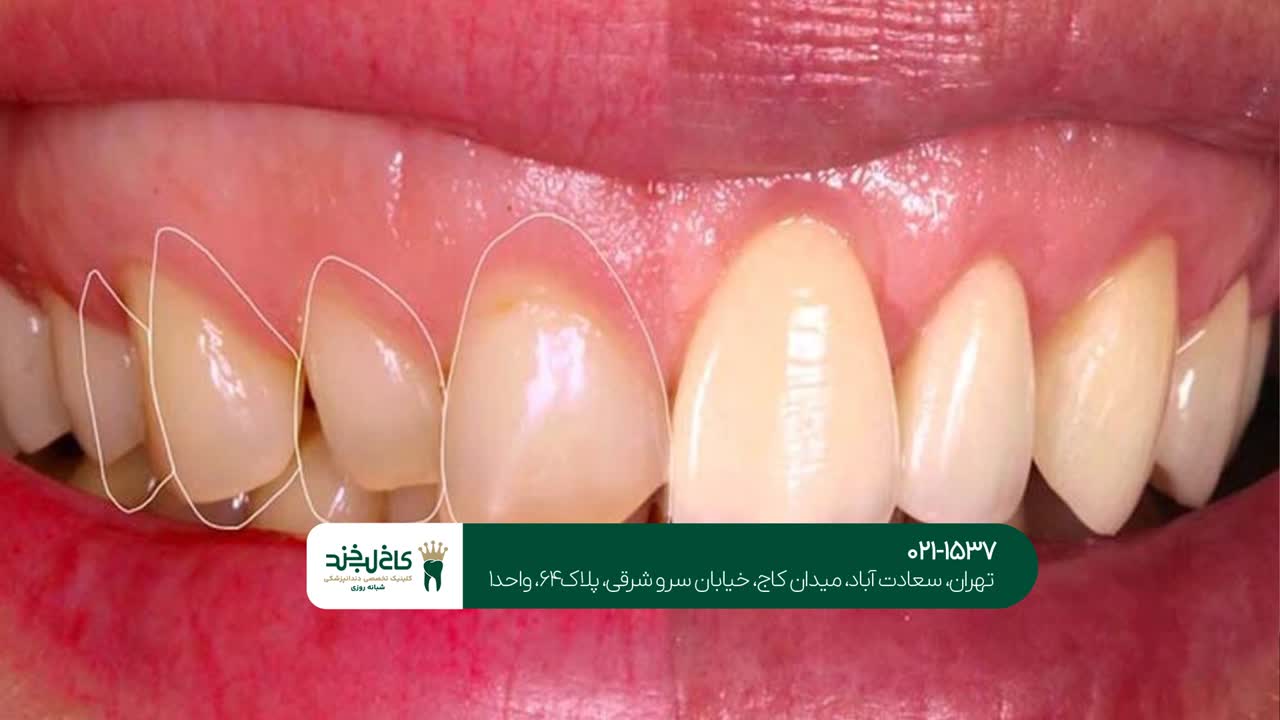 اصلاح لبخند لثهای اصلاح لبخند لثهای