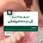 تزریق بوتاکس و ژل در دندانپزشکی