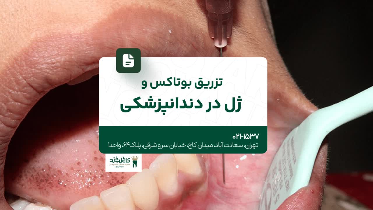 تزریق بوتاکس و ژل در دندانپزشکی تزریق بوتاکس و ژل در دندانپزشکی