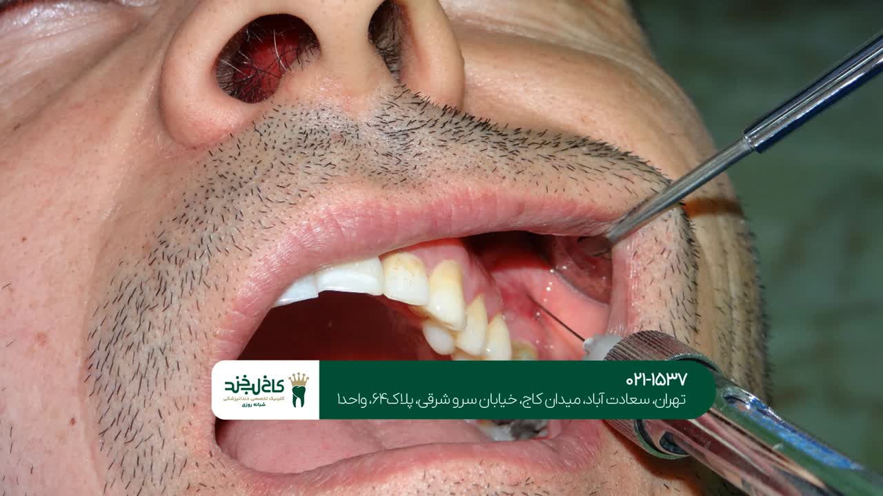 تزریق بوتاکس و ژل تزریق بوتاکس و ژل