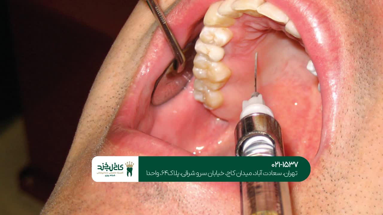 تزریق ژل در دندانپزشکی تزریق ژل در دندانپزشکی