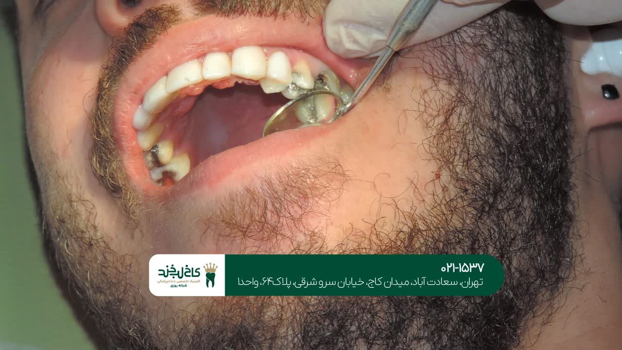 تزریق بوتاکس در دندانپزشکی تزریق بوتاکس در دندانپزشکی