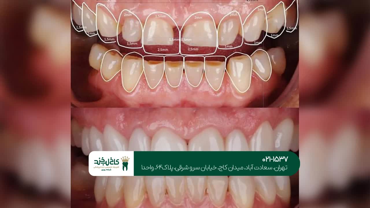 هزینه طراحی لبخند در تهران هزینه طراحی لبخند در تهران