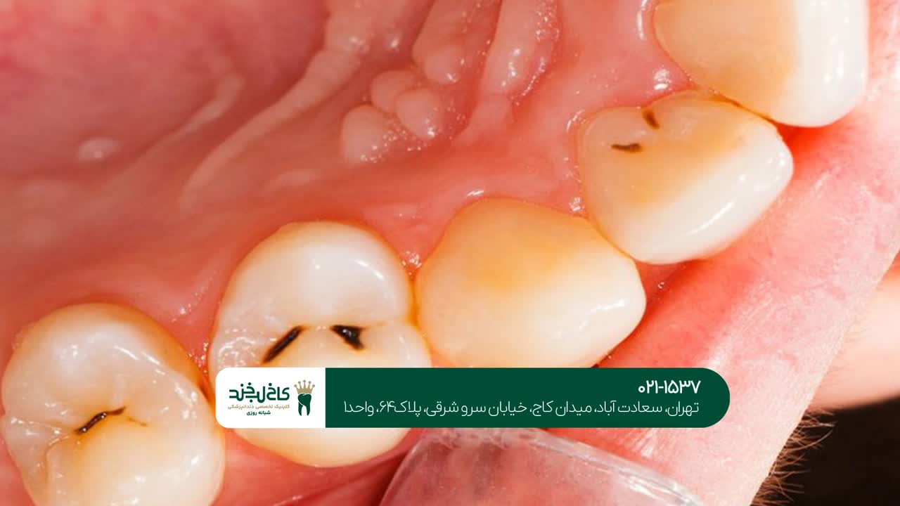 درمان دندانهای خراب