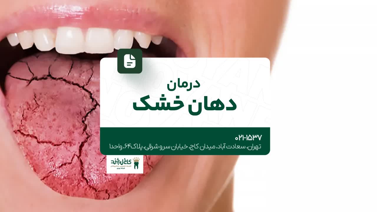 درمان دهان خشک