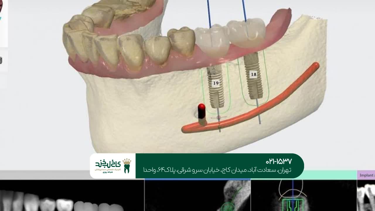 ایمپلنت دندان به صورت دیجیتال