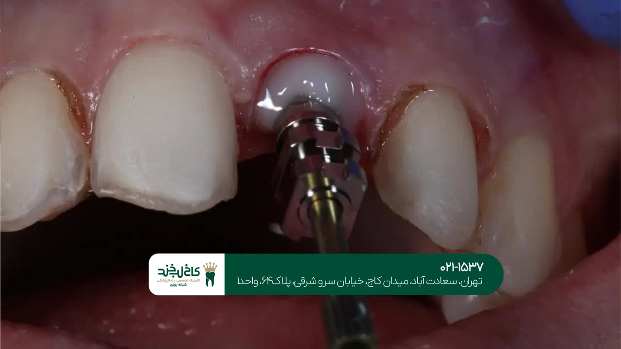 درمان ایمپلنت با لیزر