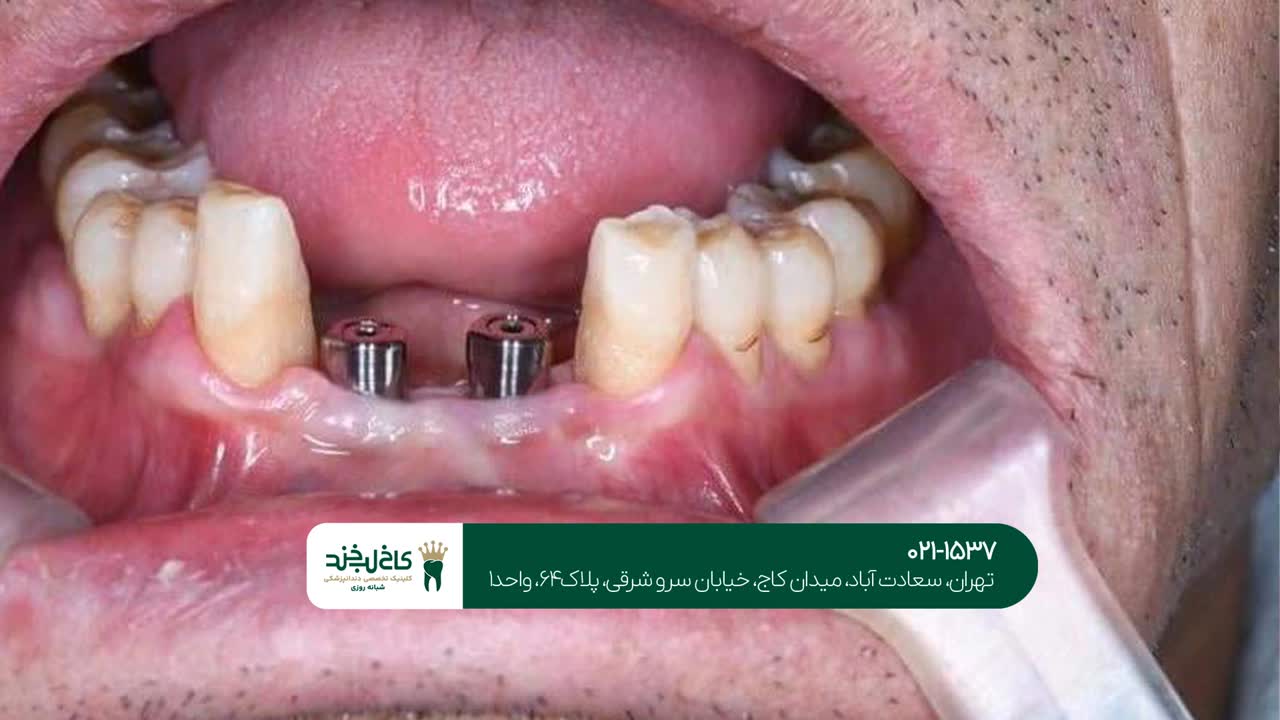 بهترین روشهای ایمپلنت دندان