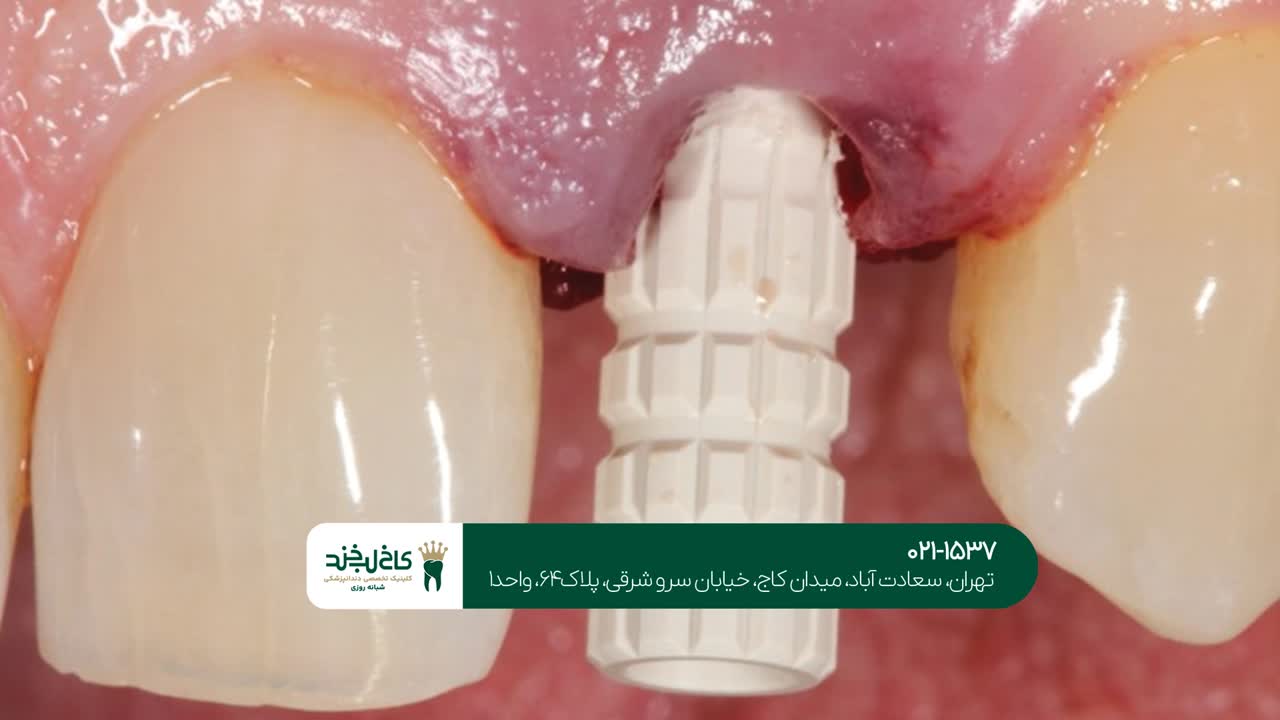 ایمپلنت دندان یک روزه
