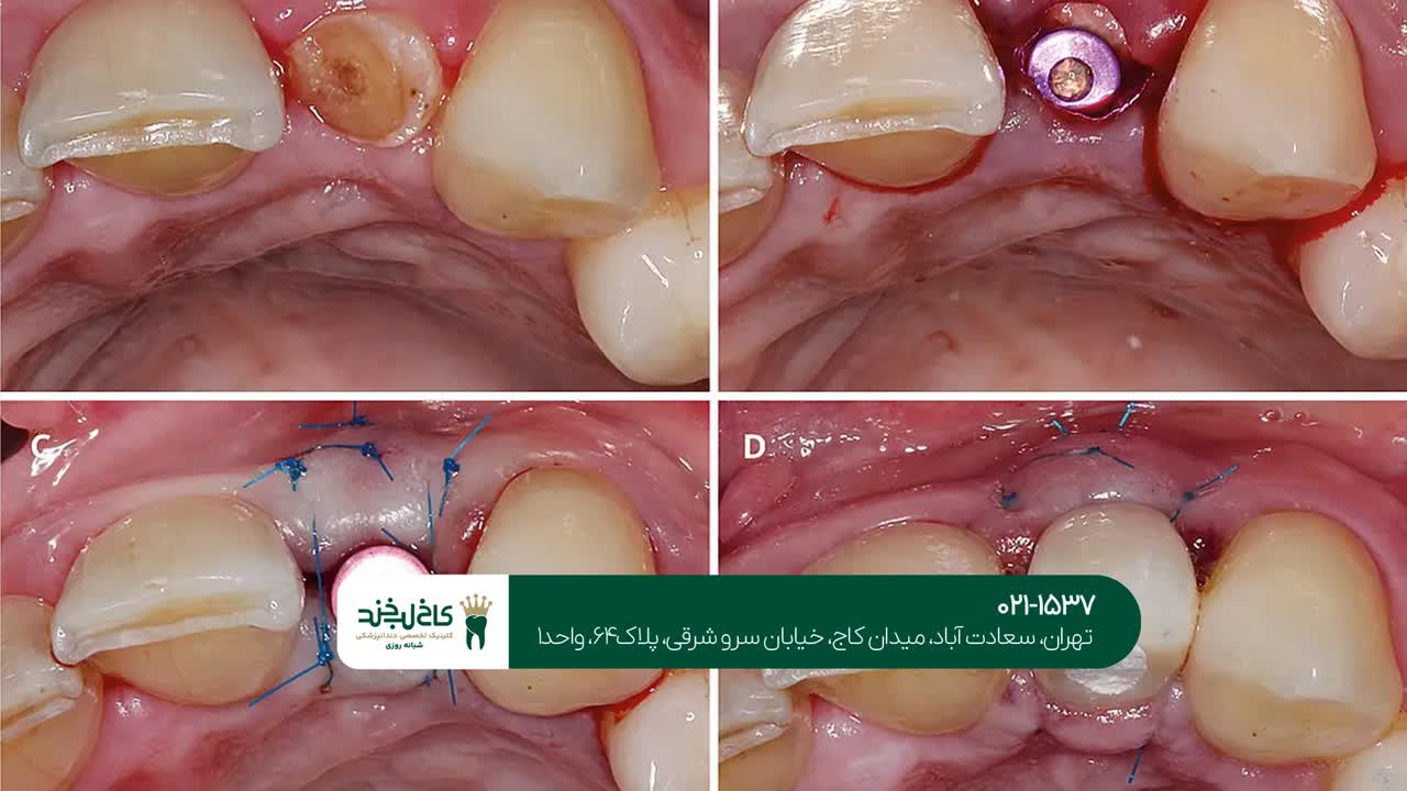 ایمپلنت دندان با سرعت بالا