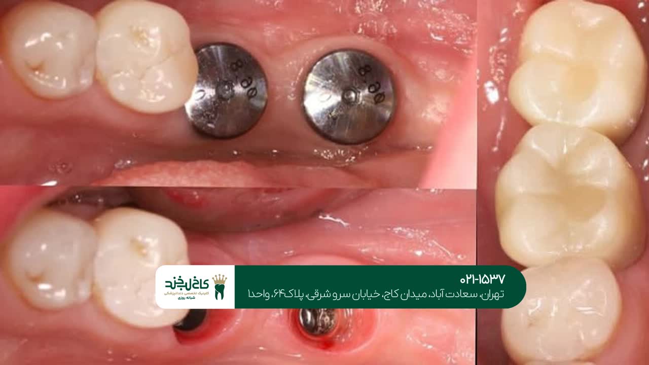 کاشت ایمپلنت دندان بدون جراحی
