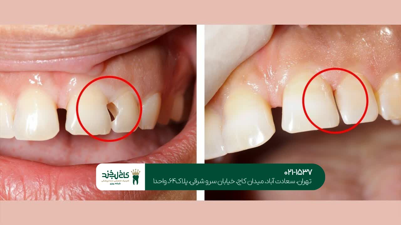 درمان دندان های پوسیده شدید