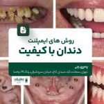 روشهای ایمپلنت دندان با کیفیت