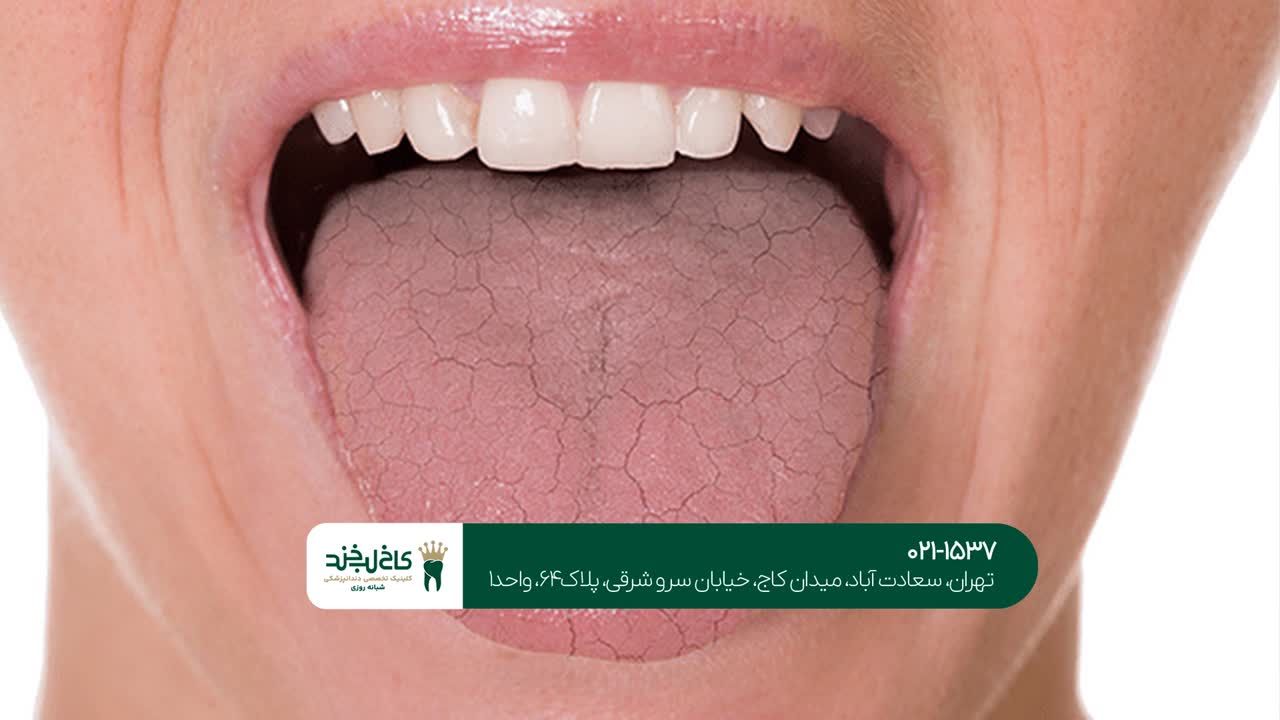 درمان دهان خشک