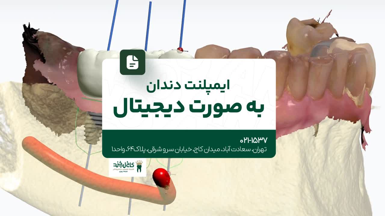 ایمپلنت دندان به صورت دیجیتال