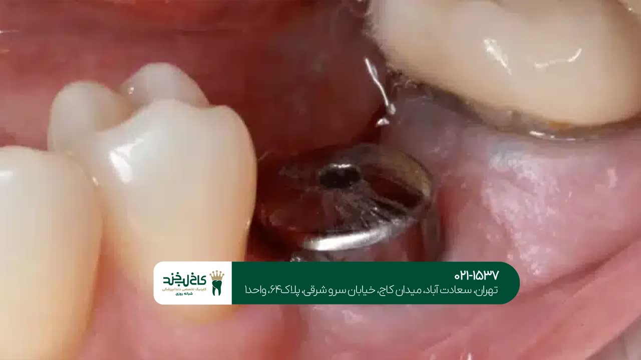 درمان ایمپلنت با لیزر