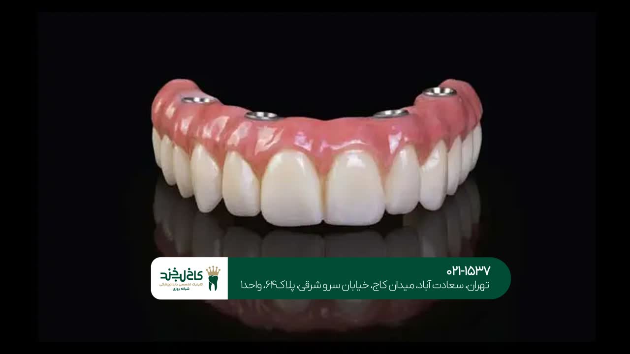 پروتز ایمپلنت در تهران