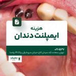بهترین روشهای ایمپلنت دندان