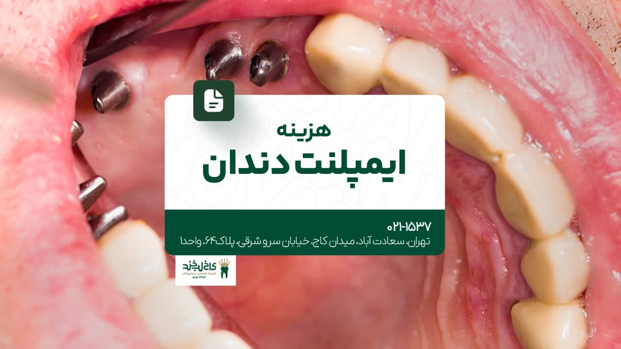 بهترین روشهای ایمپلنت دندان