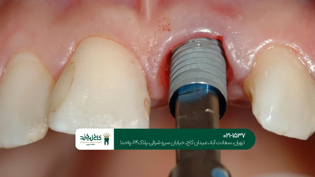 ایمپلنت دندان یک روزه