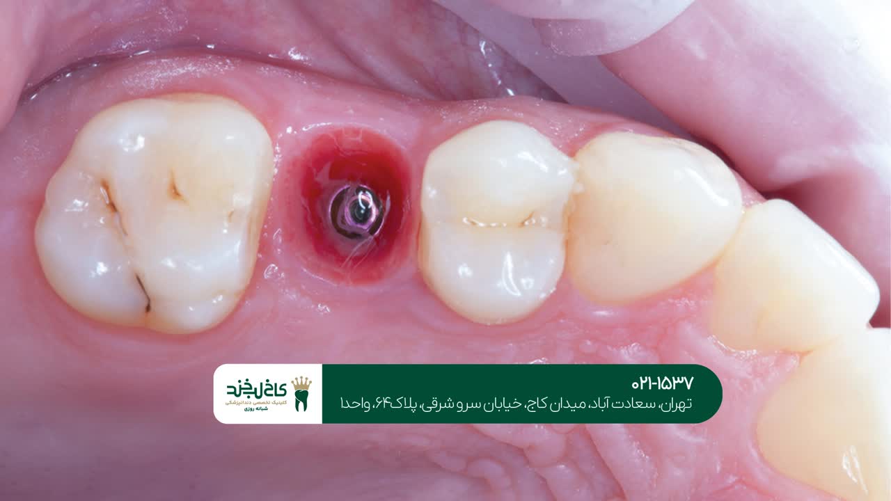 ایمپلنت دندان با سرعت بالا