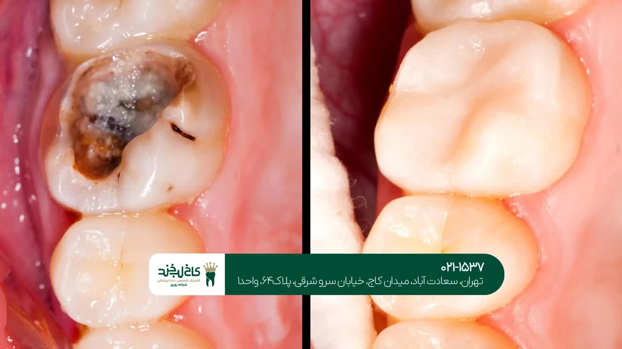 درمان دندان های پوسیده شدید