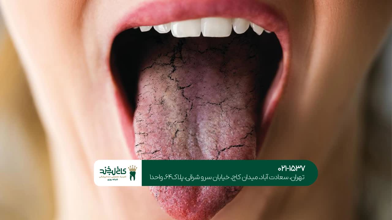 درمان دهان خشک