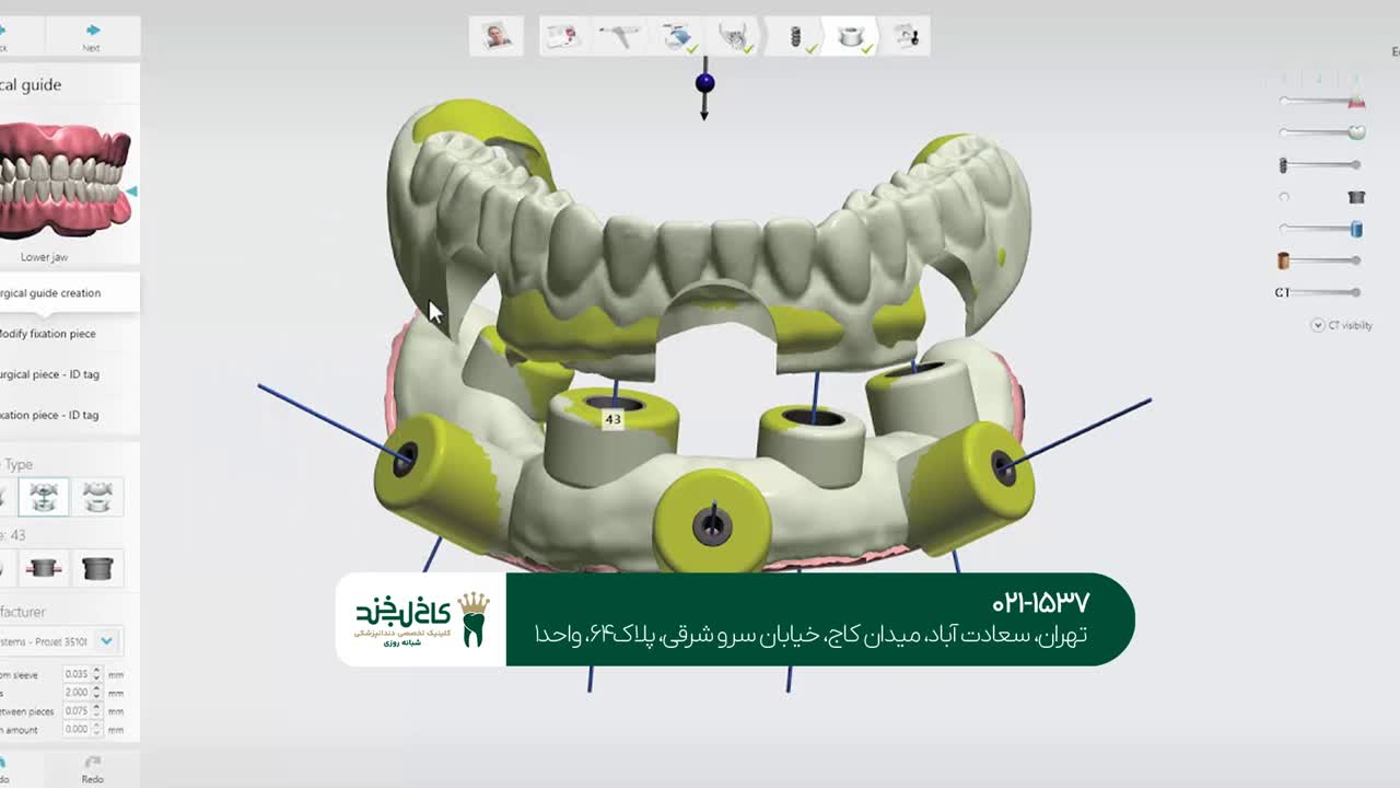 ایمپلنت دندان به صورت دیجیتال