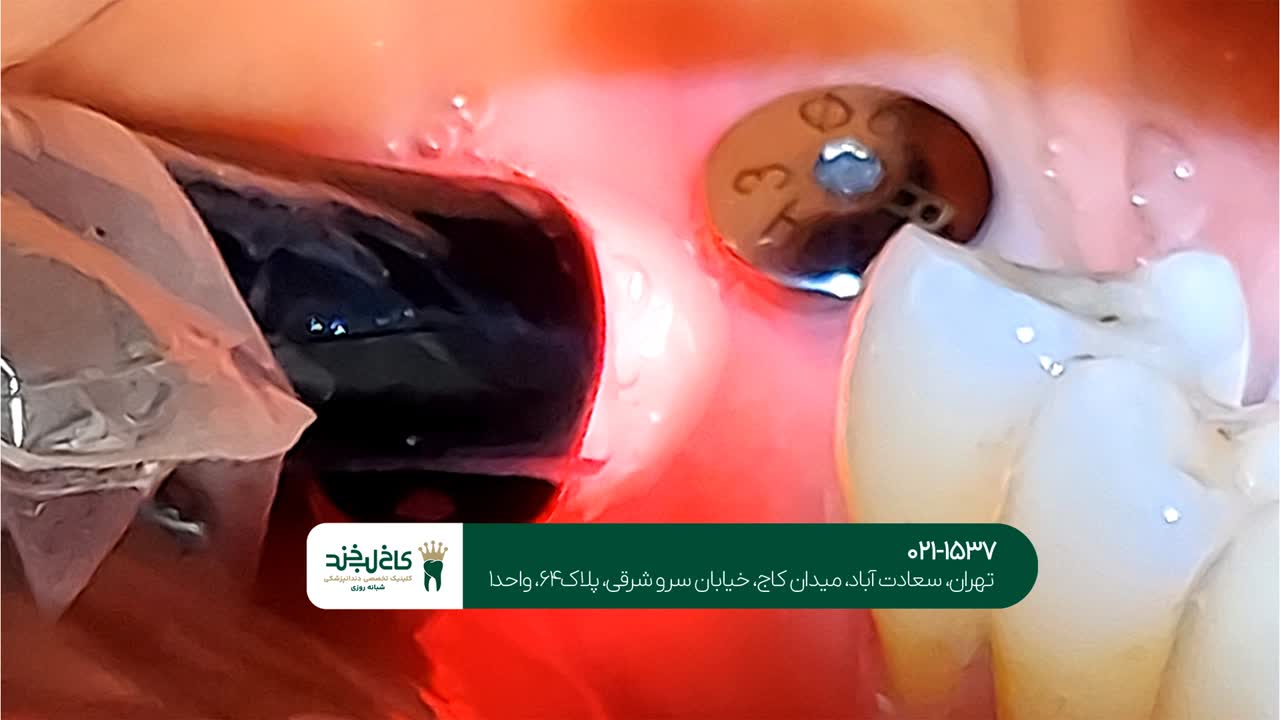 درمان ایمپلنت با لیزر