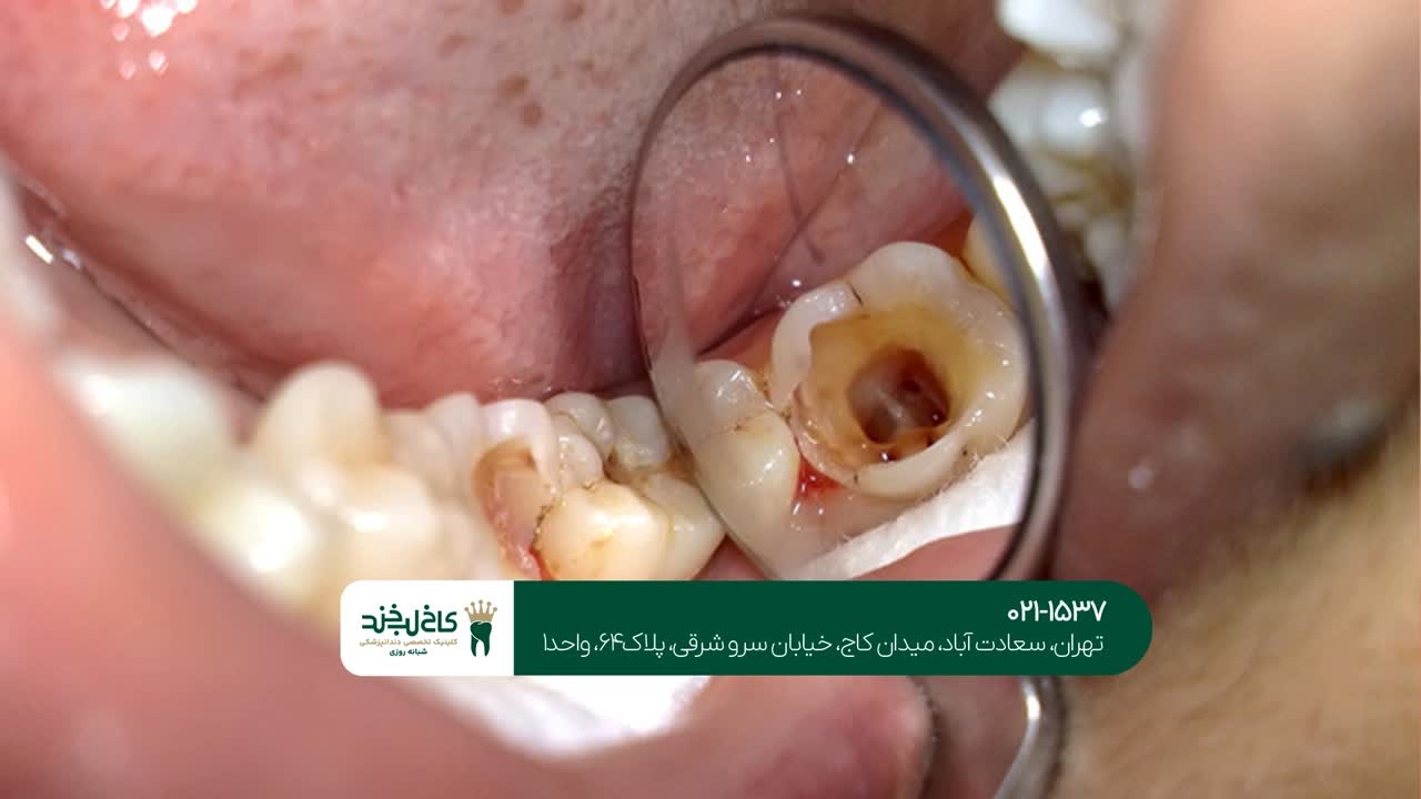 درمان دندانهای آسیب دیده