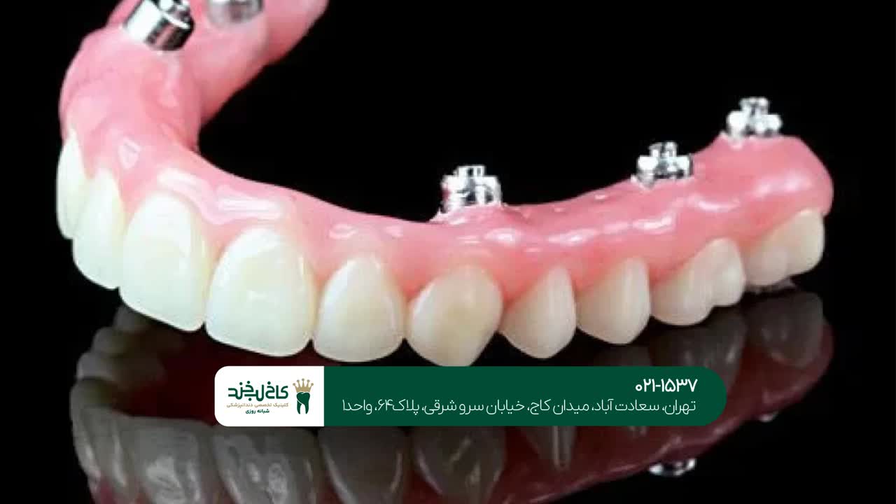 پروتز ایمپلنت در تهران