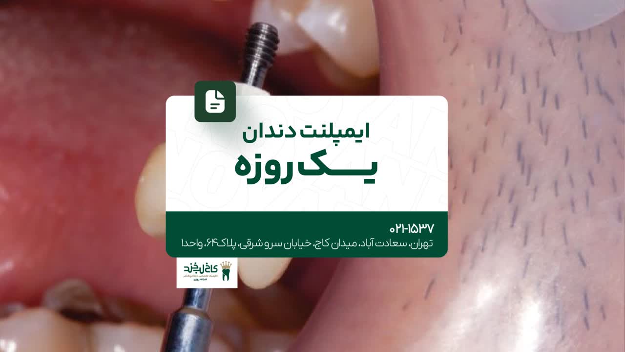 ایمپلنت دندان یک روزه