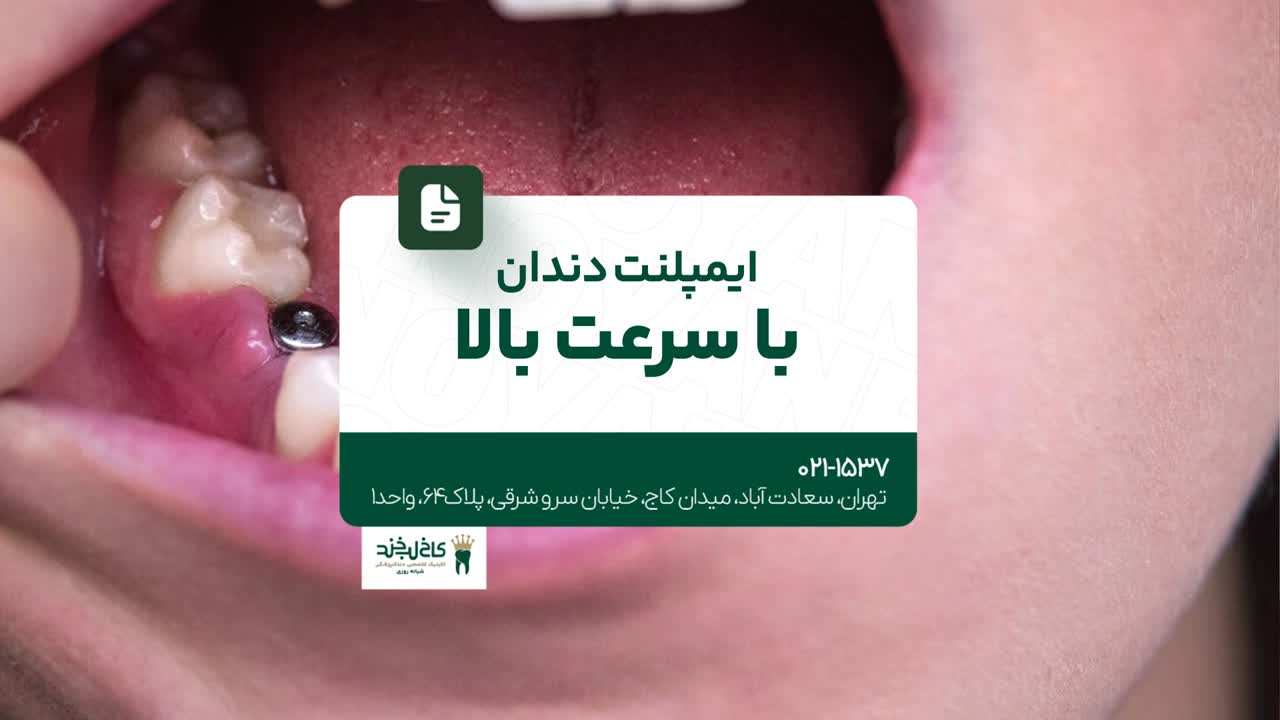 ایمپلنت دندان با سرعت بالا