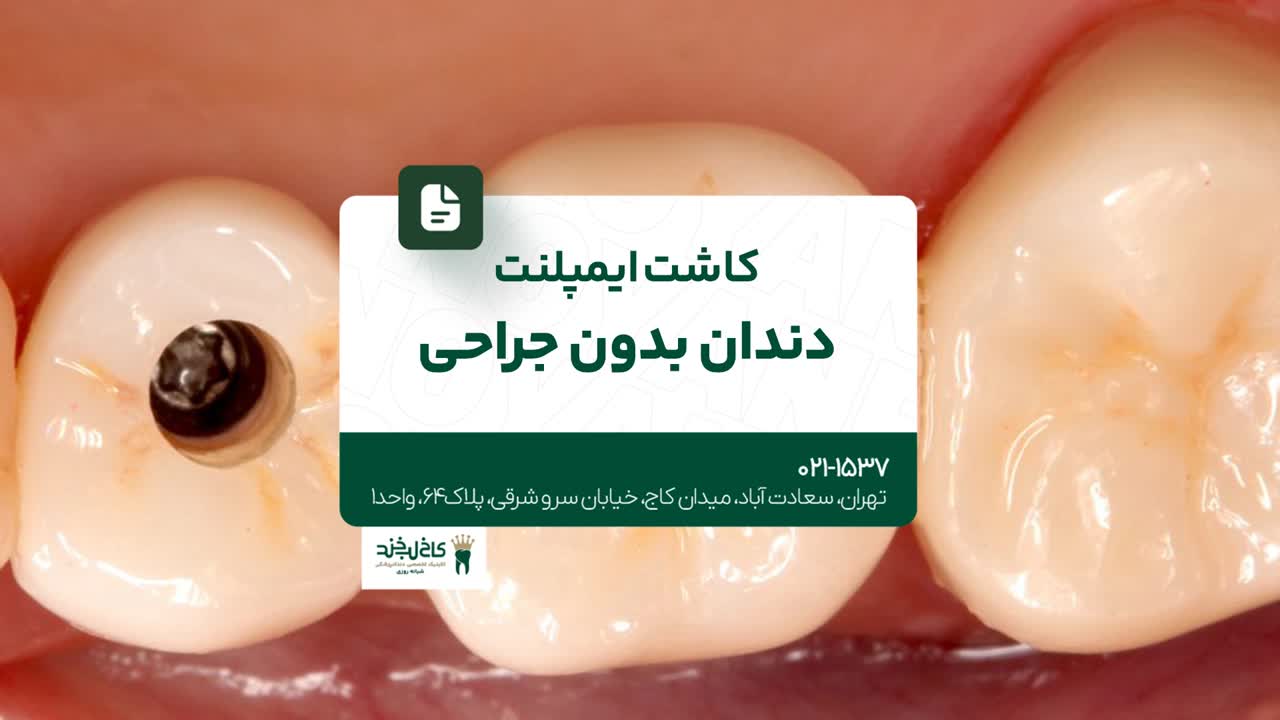 کاشت ایمپلنت دندان بدون جراحی