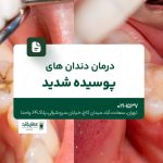 درمان دندان های پوسیده شدید