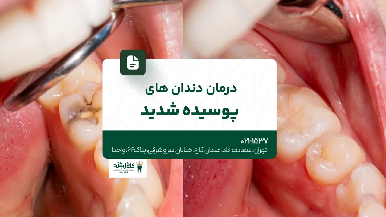 درمان دندان های پوسیده شدید