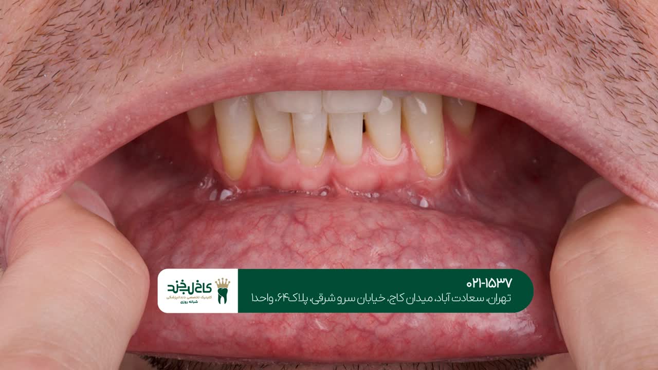 درمان بیماریهای دهان