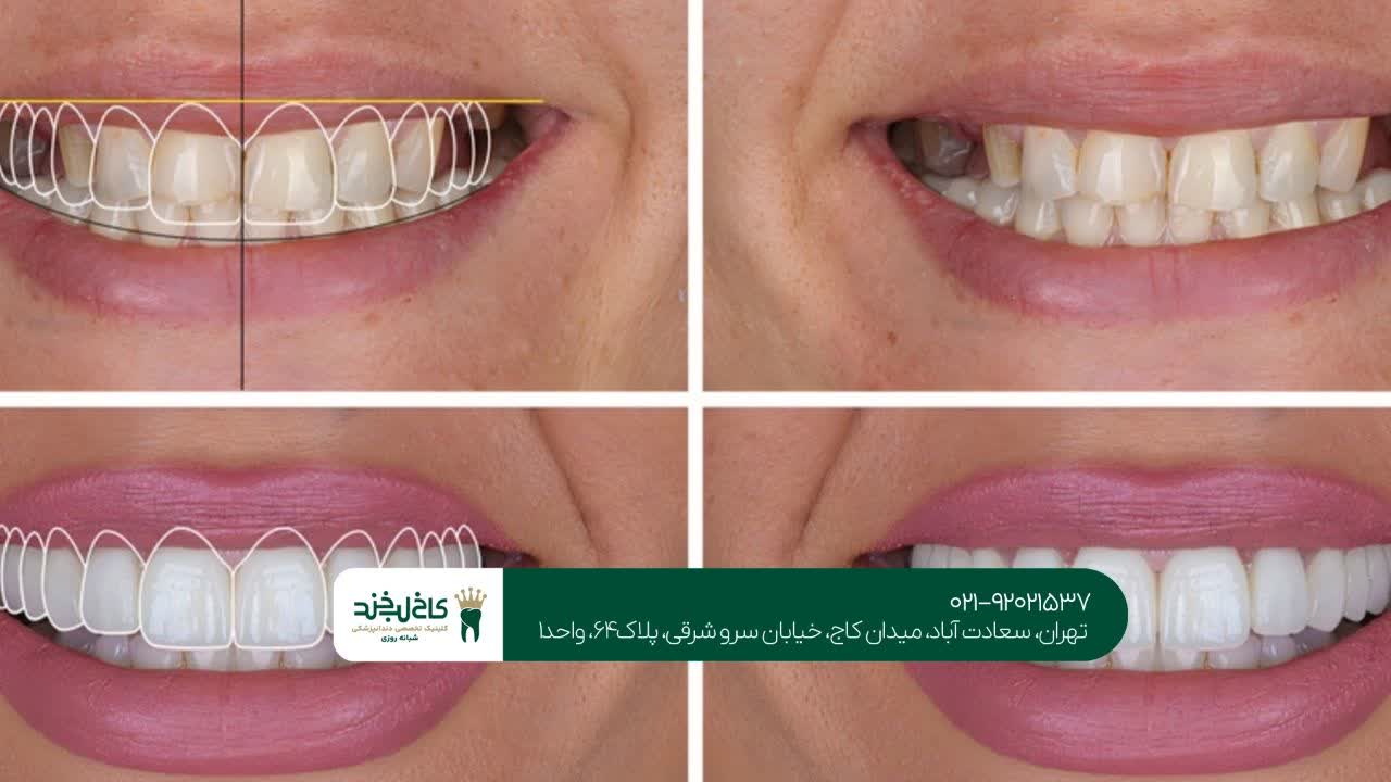 طراحی دیجیتال لبخند طراحی دیجیتال لبخند