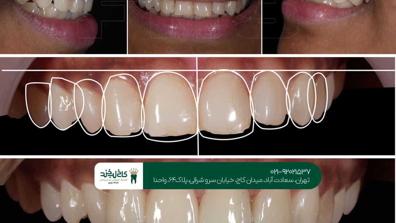 طراحی لبخند دیجیتال طراحی لبخند دیجیتال