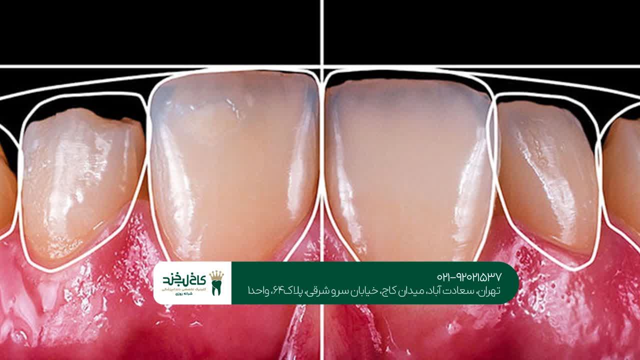 طراحی لبخند دیجیتال طراحی لبخند دیجیتال