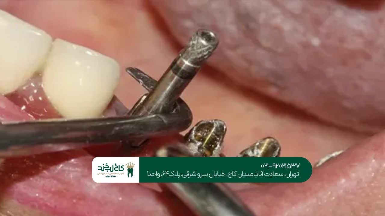 ایمپلنت سعادت آباد ایمپلنت سعادت آباد