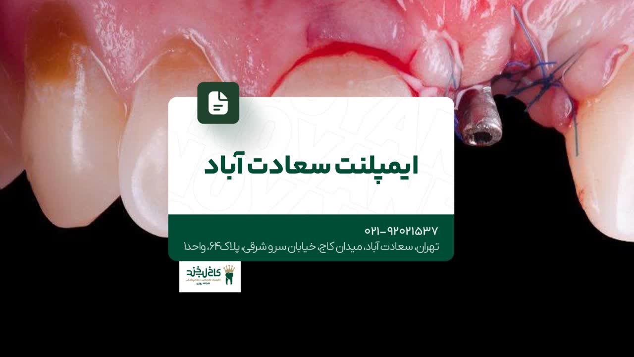 ایمپلنت سعادت آباد ایمپلنت سعادت آباد