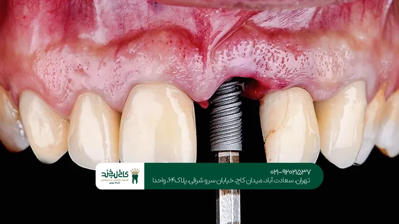 دندانپزشکی ایمپلنت تهران دندانپزشکی ایمپلنت تهران